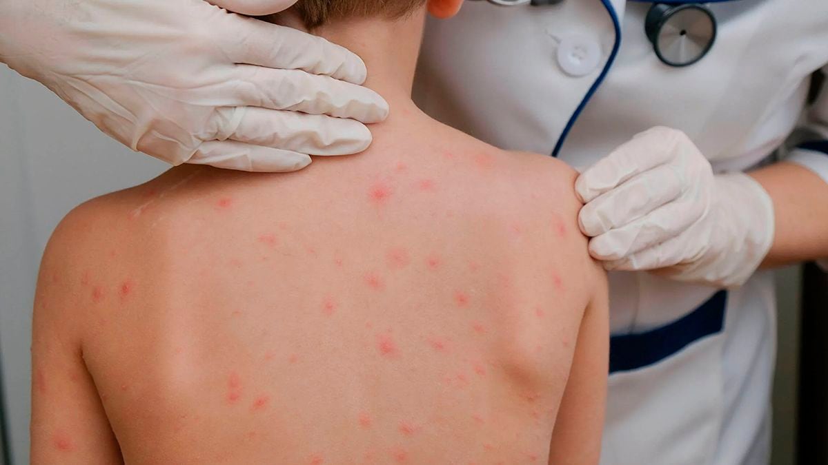 Varicela en dos escuelas de Neuquén: lo que hay que saber para prevenir nuevos contagios