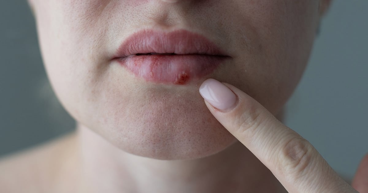 Después de casi treinta años, hay un antiviral oral nuevo para el herpes que se hace resistente