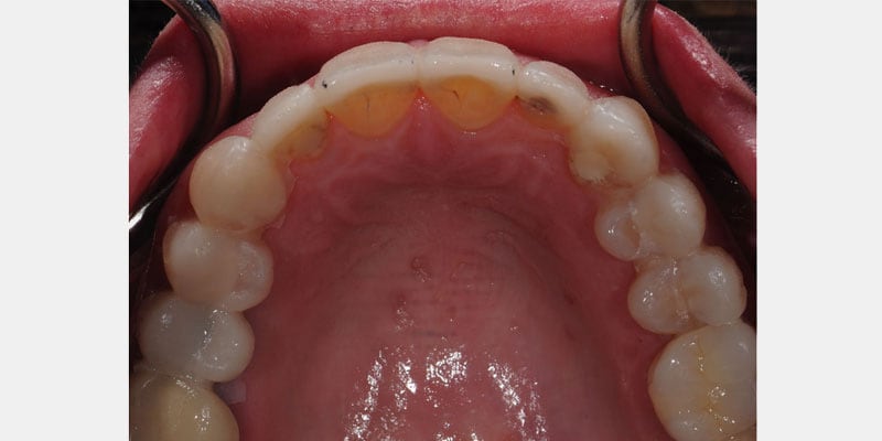 Carillas dentales: los sinais tempranos de una filtración y cómo actuar a tiempo